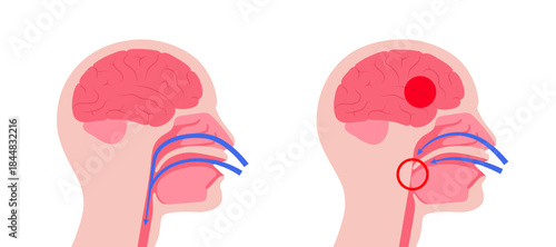 Obstructive sleep apnea