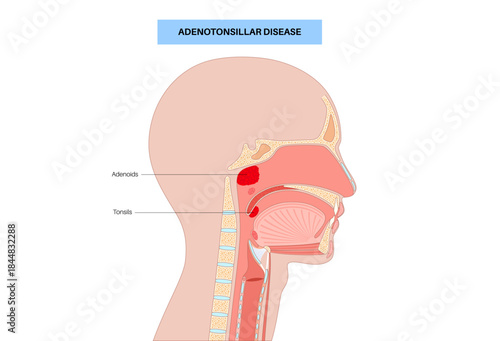 Adenotonsillar disease poster