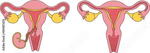 Female Reproductive System Illustration Showing Tubal Pregnancy and Normal Uterus Anatomy for Education