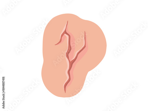 Scar Repaired Tissue