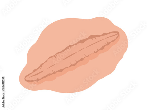 Scar Tissue Repair Clip Art