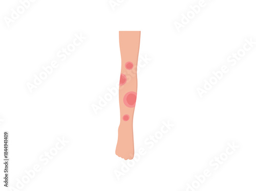 Erythema Nodosum in Skin