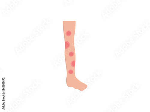 Erythema Nodosum Redness