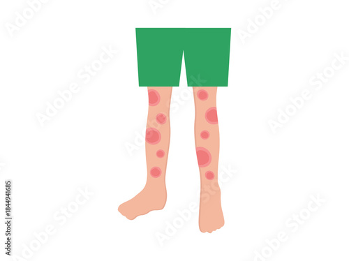 Erythema Nodosum Redness
