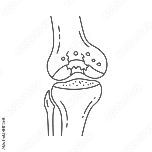 Clear Knee Joint Anatomy Bone Cartilage Fracture Medical Diagram Illustration Orthopedics