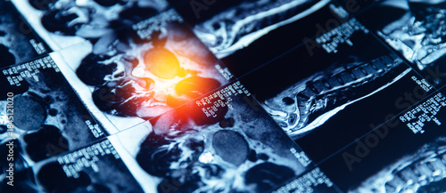 Mri scan of spinal column highlighting disc protrusion and vertebral structure banner, pinched sciatic nerve in leg