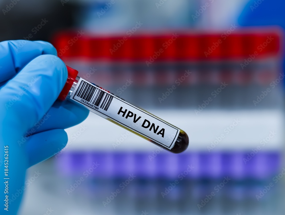 Naklejka premium Blood sample tube for HPV DNA test analysis.