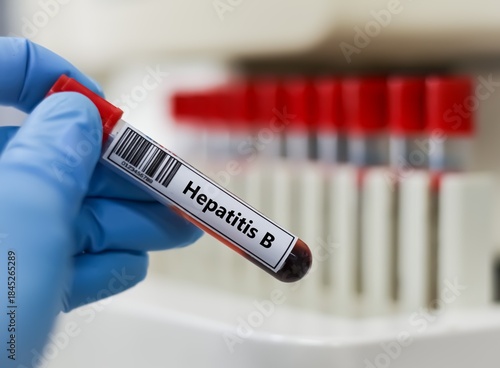 Tableau sur toile Blood sample tube for hepatitis B virus test analysis.