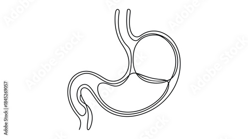  Medical illustration of human stomach anatomy with adjustable gastric band for bariatric surgery, showing upper pouch and digestive tract for weight loss and obesity treatment