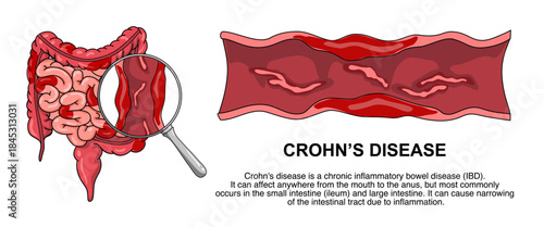Illustration of Crohn's disease. inflammatory bowel disease, Inflammation of the human digestive system. Vector illustration for medical, science, and educational posters.