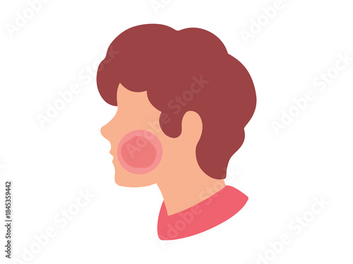 Erythema Infectiosum in Skin Illustration
