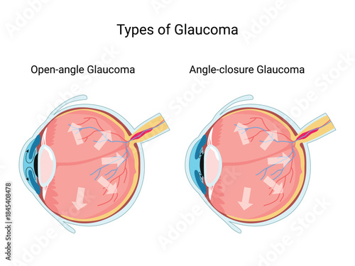 Types of Glaucoma eye. Human Eye anatomy. Eye structure, eye pressure. Treatment. Diagram for education and medical use.  Vector illustration

