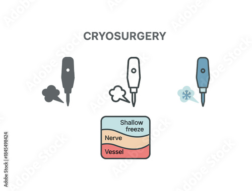 cryosurgery small nerve and vessel diagram with shallow freeze zone