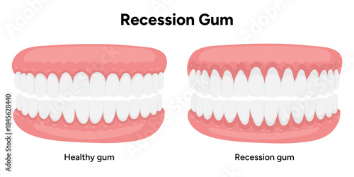 Hand-drawn dental illustration comparing gum recession and healthy gums. Educational infographic the difference between receding gums and normal gum anatomy