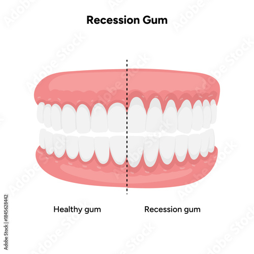 Hand-drawn dental illustration comparing gum recession and healthy gums. Educational infographic the difference between receding gums and normal gum anatomy
