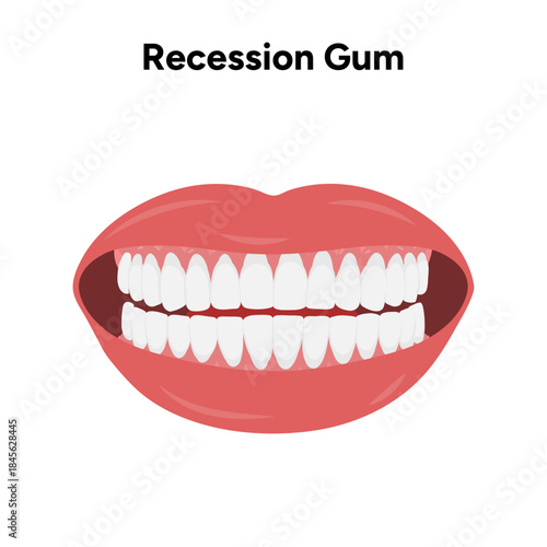 Hand-drawn dental illustration showing gum recession. Educational visual explaining receding gums and oral health problems
