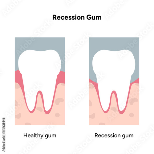 Hand-drawn dental illustration comparing gum recession and healthy gum anatomy. Educational infographic differences in tooth and gum structure
