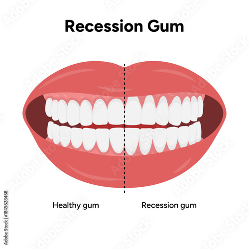 Hand-drawn dental illustration comparing gum recession and healthy gums. Educational infographic the difference between receding gums and normal gum anatomy