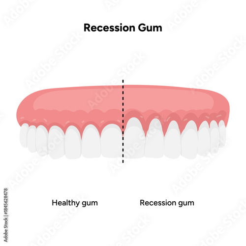 Hand-drawn dental illustration comparing gum recession and healthy gums. Educational infographic the difference between receding gums and normal gum anatomy