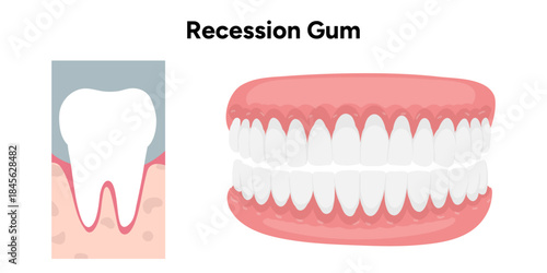 Hand-drawn dental illustration gum recession with detailed anatomy. Educational infographic differences in tooth and gum structure