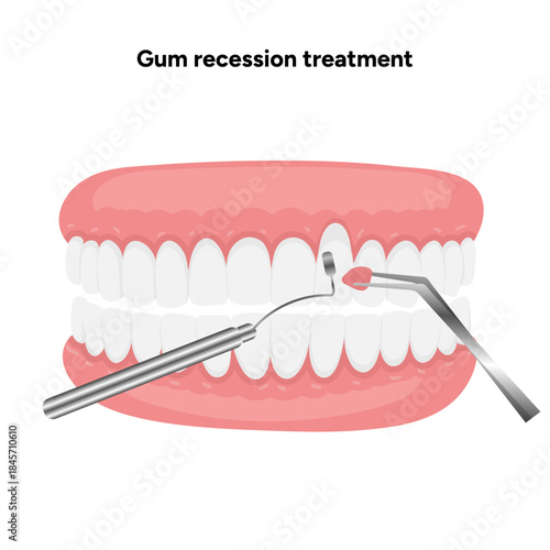 Hand-drawn dental illustration of gum recession treatment. Educational infographic healthy gums and treatment for receding gums