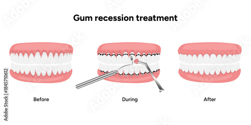 Hand-drawn dental illustration of gum recession treatment. Educational infographic healthy gums and treatment steps for receding gums