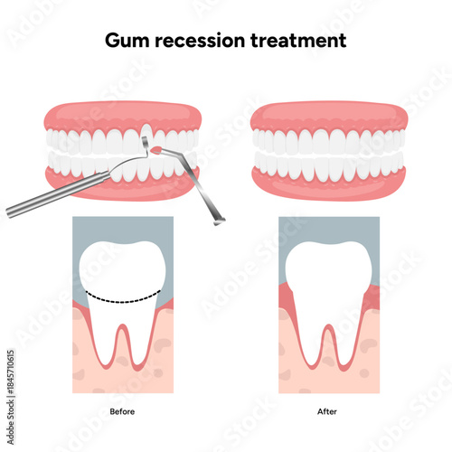 Hand-drawn dental illustration of gum recession treatment with detailed anatomy of teeth and gums