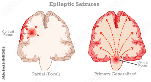 Epileptic seizures epilepsy generalized in human brain. Cross section anatomy. Focal seizures and generalized seizures types. Top view. vector illustration