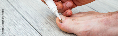 dermatologist examining patient with toenail fungus. A doctor examines bare foot with onycholysis on a toenail after damaging with tight shoes or using gel-lacquer.