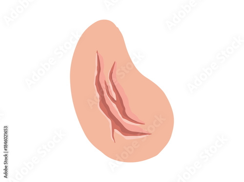 Fissure Deep Crack in Skin