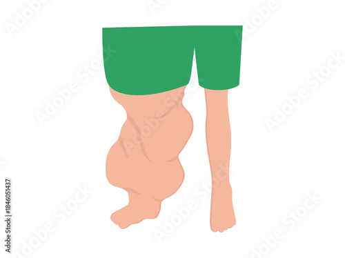 Elephantiasis Disease from Filaria Worm Parasite
