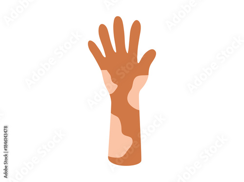 Vitiligo Pigment Loss Clip Art
