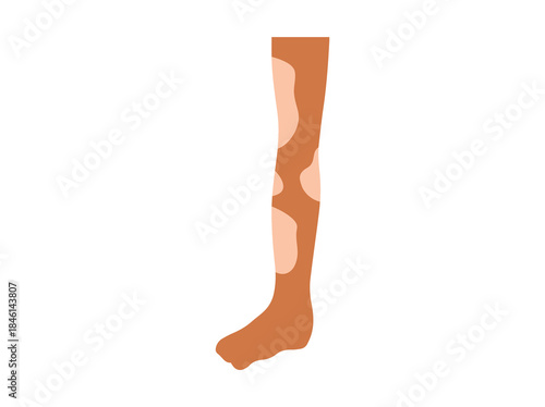 Vitiligo Pigment Loss Clip Art
