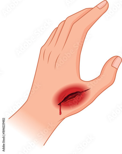 Hand Injury with Open Wound Medical Illustration