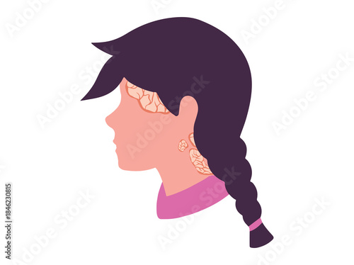 Psoriasis on the Scalp Illustration
