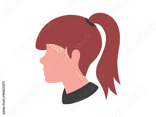 Hand Drawn Scalp Psoriasis Disease
