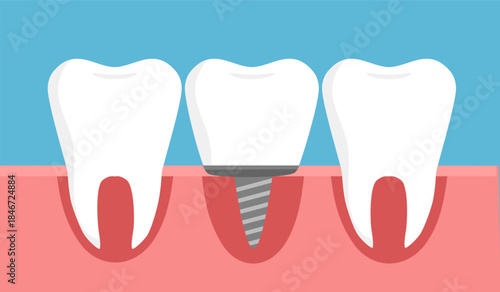 Illustration of tooth implantation, tooth restoration, tooth on a light blue background, Vector illustration