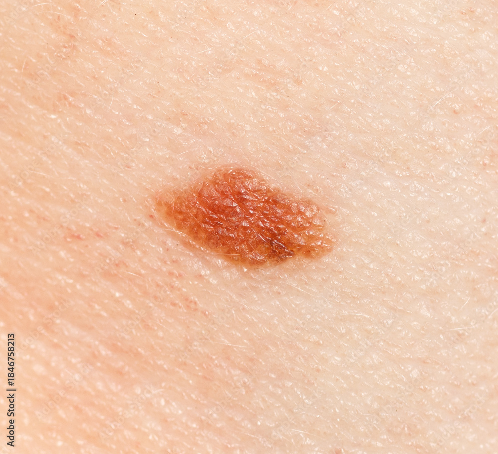 Fototapeta premium A small brown spot on a person's arm
