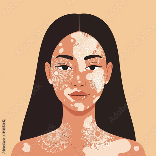 Vector Portrait of Woman with Vitiligo Skin and Decorative Patterns