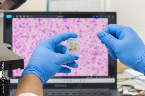 Scientist wear blue glove holding glasses slide and human tissue block and out of focus computer monitor show glandular image from microscope.Medical patholology and cytology laboratory technology