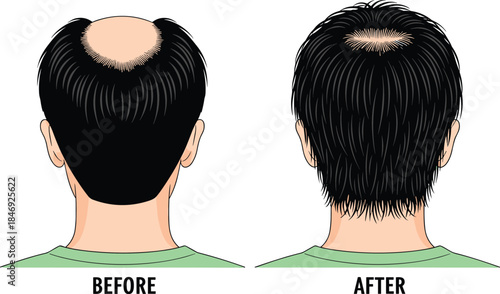 Before and after hair regrowth illustration showing bald spot treatment results, scalp improvement, hair restoration success, and male alopecia solution