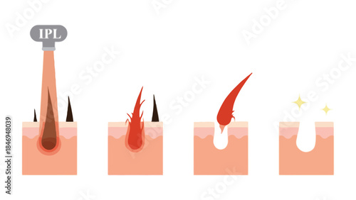 IPL hair removal process on skin