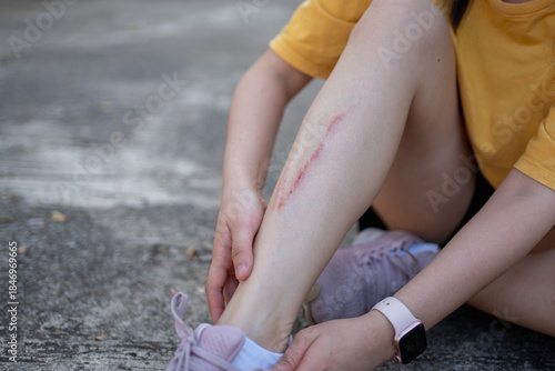 Fotografia Minor leg injury with scrape after falling on pavement