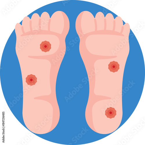 Indicates diabetes-related foot conditions and the need for proper hygiene, protection, and medical attention.