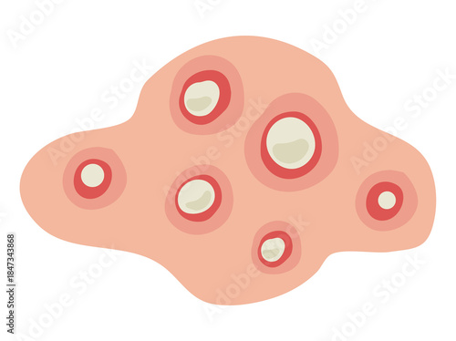 Hand Drawn Acne Pustule in Skin
