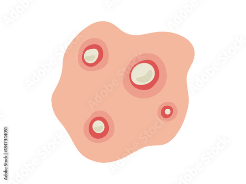 Hand Drawn Acne Pustule in Skin
