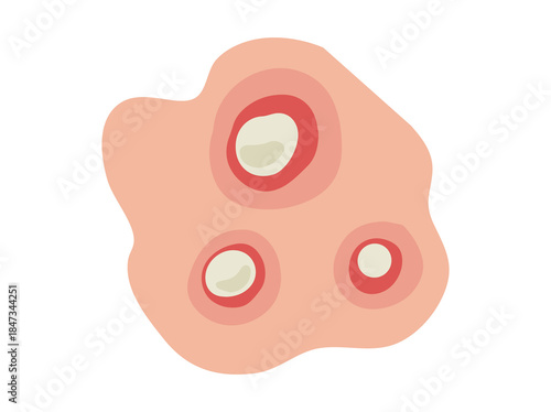 Acne Pustule in Skin Clip Art
