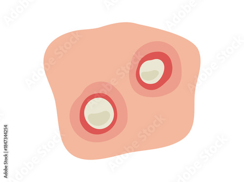 Acne Pustule in Skin Clip Art
