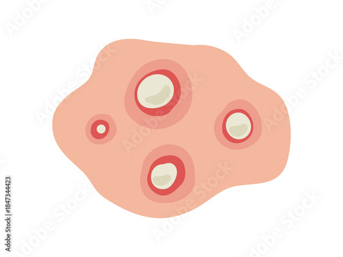 Acne Pustule Illustration

