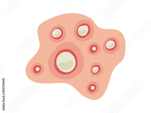Acne Pustule Illustration
